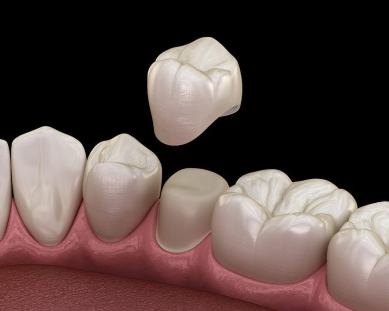 do-crowns-get-cavities-gentle-care-dentistry