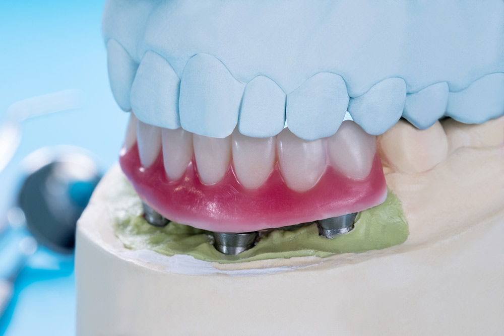 A model of an upper arch of teeth with an actual implant-supported denture underneath.