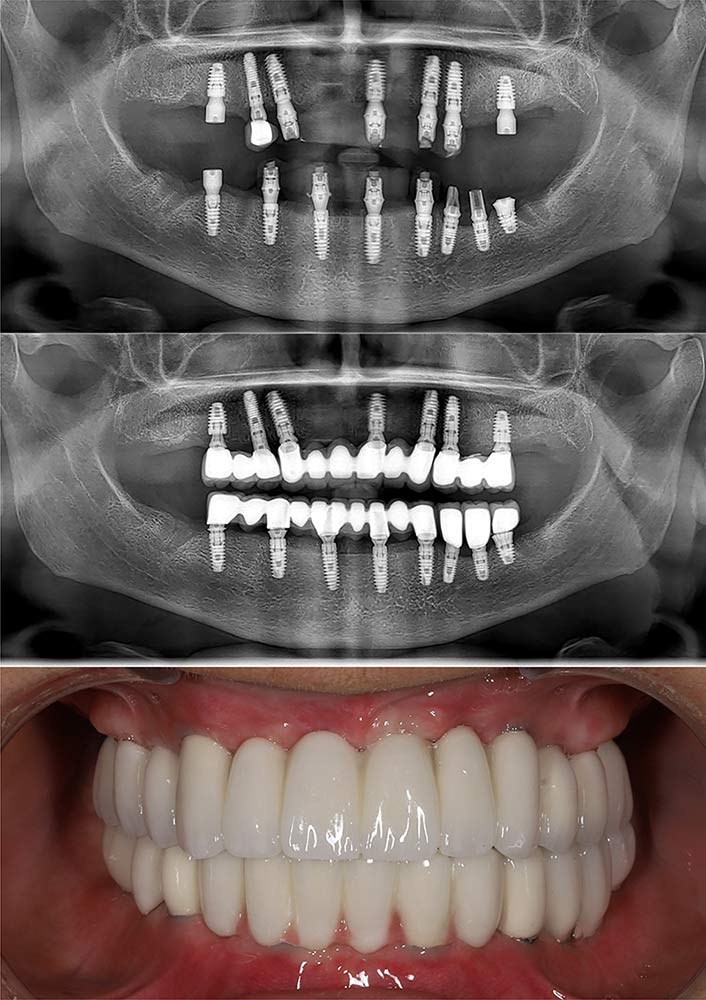 Three photos of the dental implant process, including final results.