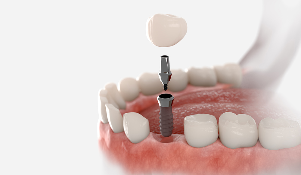 Illustration of a dental implant being inserted into healthy gums alongside other white teeth